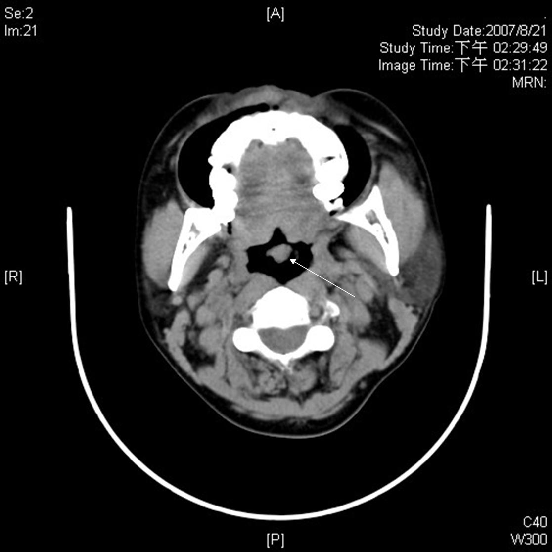 attached uvula